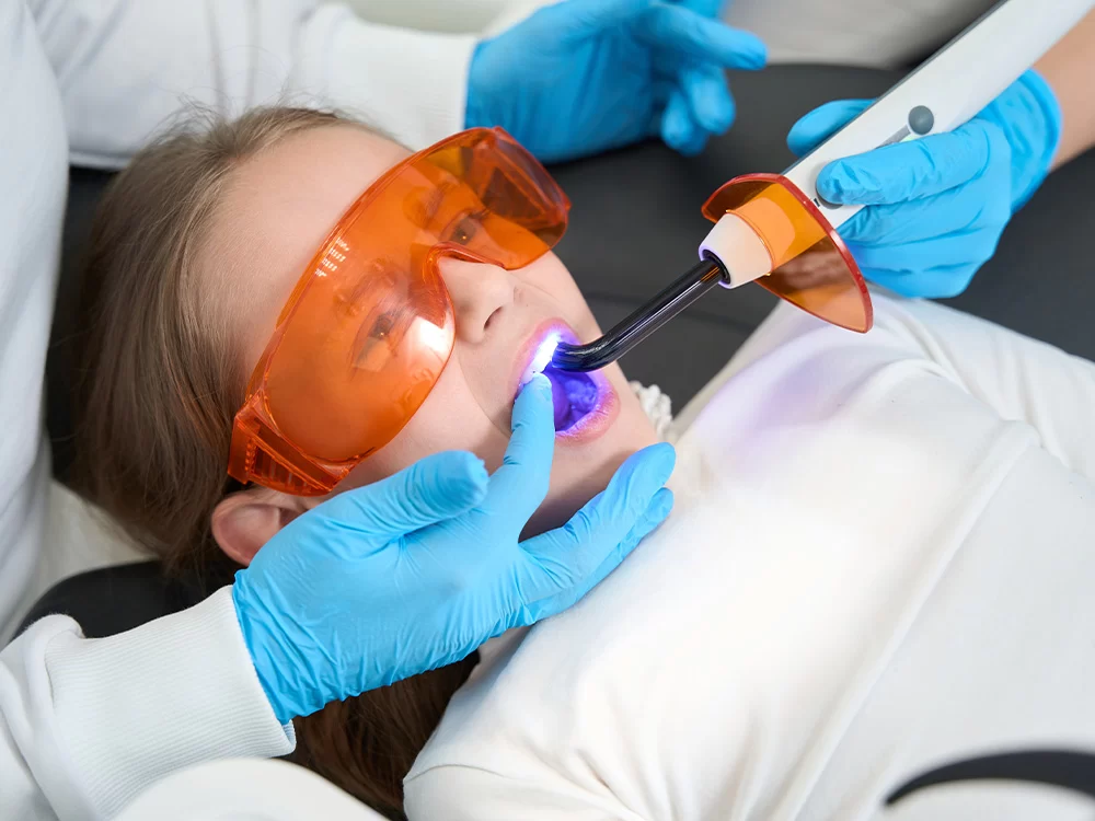 Dental Sealants